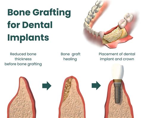 bone grafting the villages fl|Best Bone graft for dental implants .